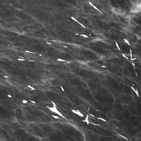Linear Breast Calcifications AJR