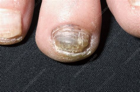 You can inhale the spores or they can land on you. Fungal nail infection - Stock Image - M270/0326 - Science ...