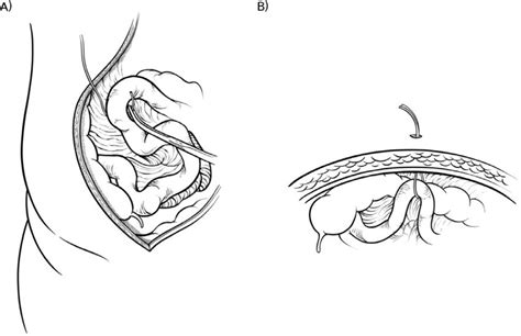 Schematic Illustration Of The Ghost Ileostomy A Silicone Loop Is