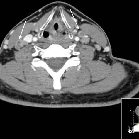 72 Year Old Female Patient With Lingual Goiter And Left Sided Paresis