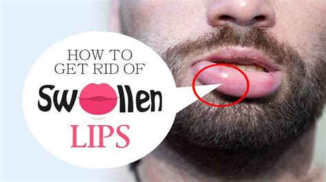 What Do Swollen Lips Mean