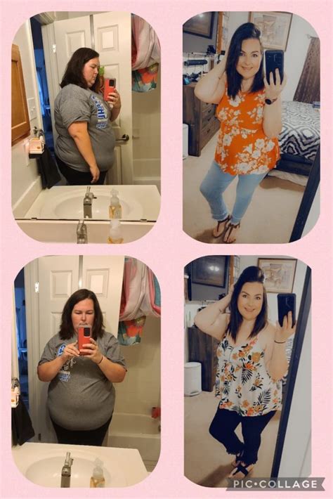 Gastric Sleeve Before And After 2022