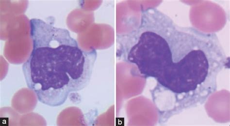 Wright Stained Specimens A Monocytes From Normal Subjects Showed