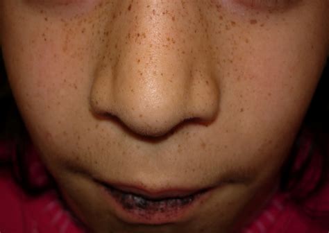 Perioral Pigmentation What Is Your Diagnosis
