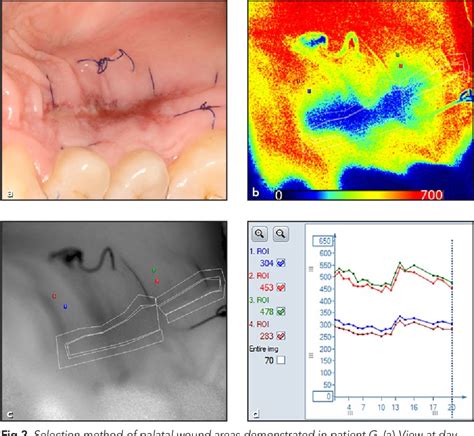 PDF Assessment Of Palatal Mucosal Wound Healing Following Connective