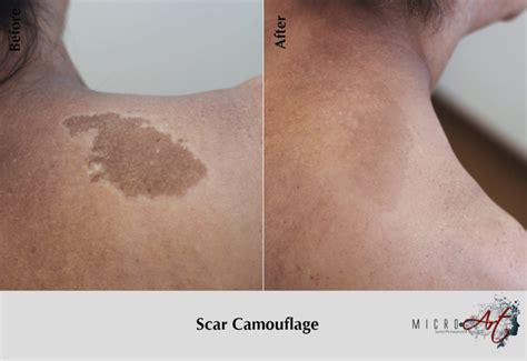 We did not find results for: Scar Treatment By MicroArt Semi Permanent Scar Camouflage