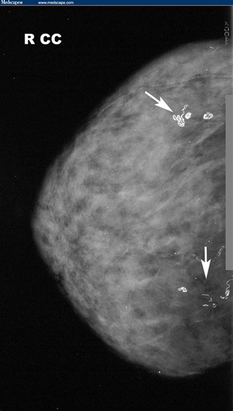 Calcium On Breast Vascular Breast Calcifications Are Benign Breast