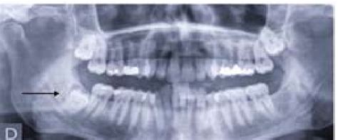 Panoramic Radiograph Showing An Impacted Lower Third Molar Completely