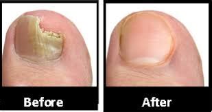 Yellow fungus is generally found in reptiles. The Cure For Yellow Toenail Fungus-High Dose Vitamin D3 ...