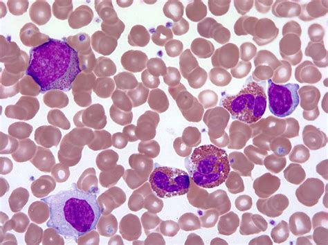 Pathology Outlines Chronic Eosinophilic Leukemia