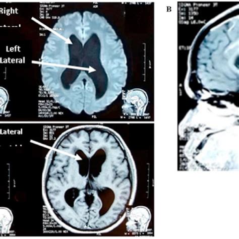 Enlargement Of The Ventricles Showed On Brain Mri A Transverse Download Scientific Diagram