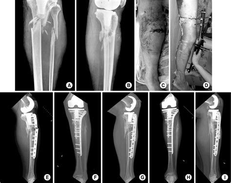 Minimally Invasive Plate Osteosynthesis For Proximal Tibial Shaft Fracture