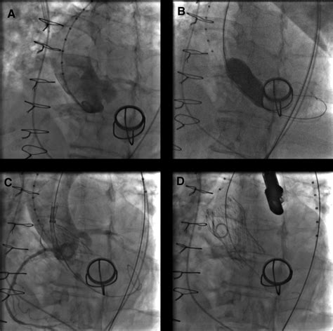 Transcatheter Aortic Valve Implantation In A Patient With Previous