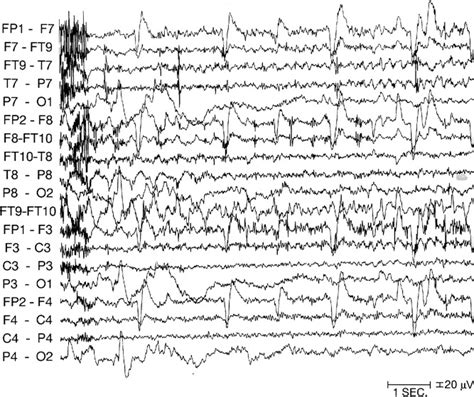 New Onset Mesial Temporal Lobe Epilepsy In A 90 Year Old Clinical And