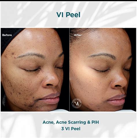 Chemical Peels For Acne Acne Scarring And Post Inflammatory