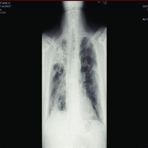 Chest X Ray On Admission A And During Hospitalization B And C