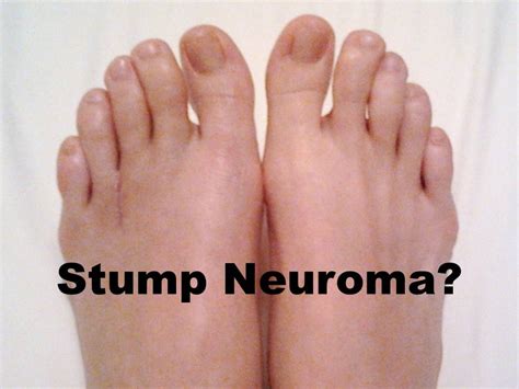 What Is A Stump Neuroma Indiana Podiatry Group