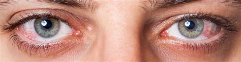 droge ogen oorzaak symptomen en behandeling ogenblik
