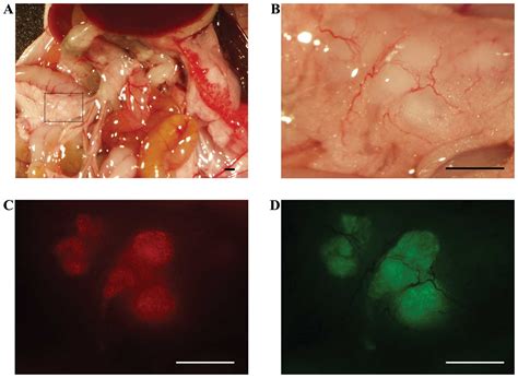 Sometimes the cancer cells from one area of the body can spread out to various other parts of the body this is recognized as secondary spread or metastasis. Fluorescent detection of peritoneal metastasis in human ...