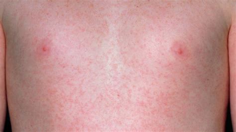Common Skin Rashes Skin And Beauty Center Everyday Health
