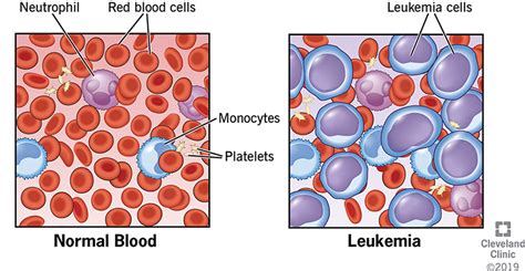 They are not bone cancers. Leukemia: Symptoms, Types, Causes & Treatments