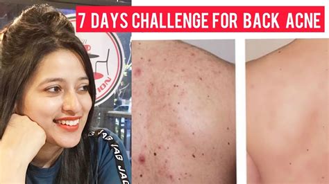 How To Get Rid Of Back Acne Bacne Scars In 7 Days Youtube