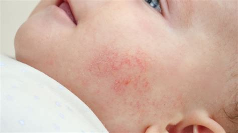 This Is What Really Causes Baby Acne