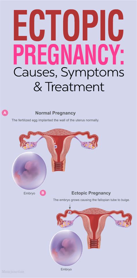 Ectopic Pregnancy Causes Symptoms Treatment And Risks