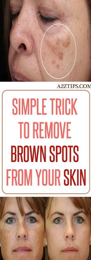 Simple Trick To Remove Brown Spots From Your Skin Wellness Guru