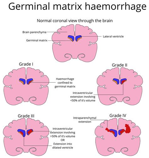 Germinal Matrix Hemorrhage Causes Symptoms Diagnosis Treatment