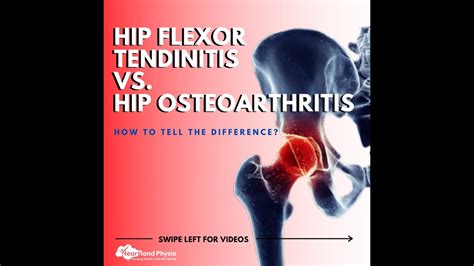 Hip Flexor Tendinitis Vs Hip Osteoarthritis Youtube