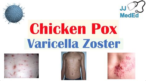 Chickenpox Varicella Zoster Virus Pathogenesis Signs And Symptoms