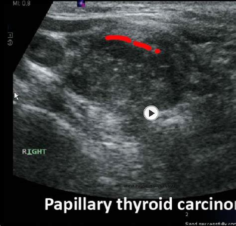 Practical Approach To Thyroid Nodulesultrasound Criteria For