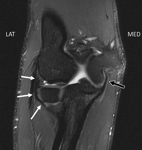Elbow Imaging In Sport Sports Imaging Series Radiology