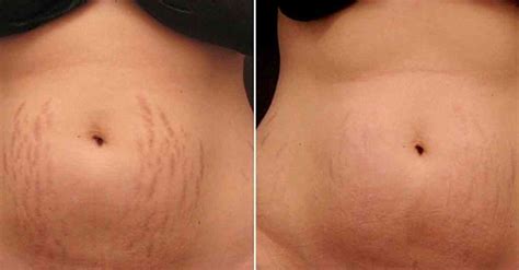 Microneedling Before After Impressions Medispa