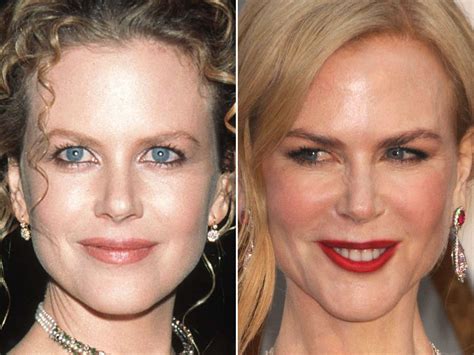 Nicole Kidman Plastic Surgery Before And After Pictur