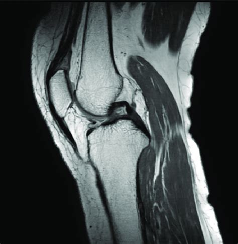 Left Knee Magnetic Resonance Image Of The Edematous Change Of The