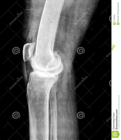 X Ray Of Knee Stock Image Image Of Human Process Surgery 47702845