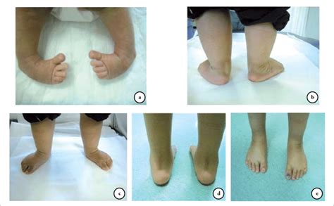 The foot points downward, and the toes may be curled inward. Clinical photographs showing a) the club feet of a 1.5 ...