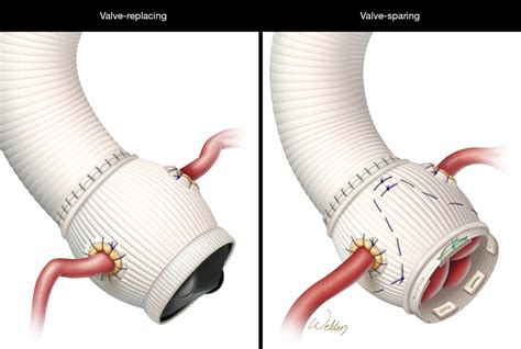 Valve Sparing Versus Valve Replacing Aortic Root Operations In Patients