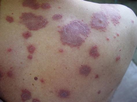 Leukemia Skin Rash