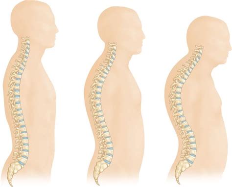Example scenario with backbone fast feature enabled configure backbone fast for catos and cisco ios this document describes how to configure backbone fast. Osteoporosis and Spinal Fractures - OrthoInfo - AAOS