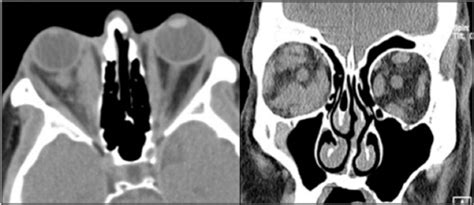 Wills Eye Resident Case Series - Diagnosis & Discussion