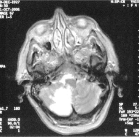 A 74 Year Old Female Patient With Right Frontotemporal Headache