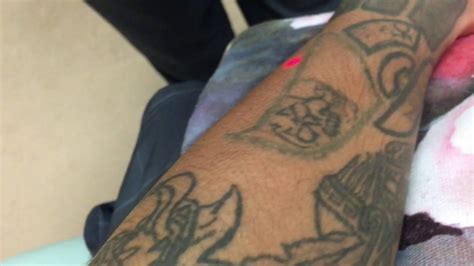 The person may need repeated sessions to lighten the tattoo and it might not be possible to completely erase the tattoo. Tattoo removal first session video #1 Wisconsin laser ...