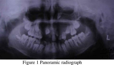 Non Syndromic Bilateral Dentigerous Cysts A Case Report Semantic Scholar