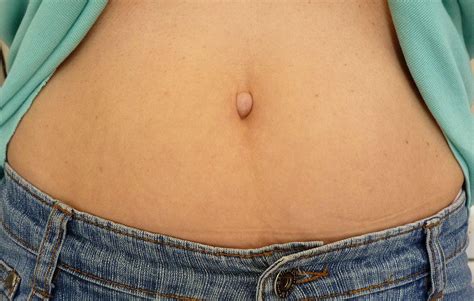 Belly button itching after eating. "Umbilical protrusion (an outie) was unappealing," the researchers wrote in the journal Plastic ...