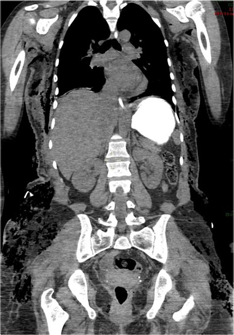 Ct Scan Showing Subcutaneous Emphysema Extending From The Soft Tissues