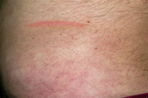 Bruise From Abdominal Injury Photograph By Dr P Marazziscience Photo