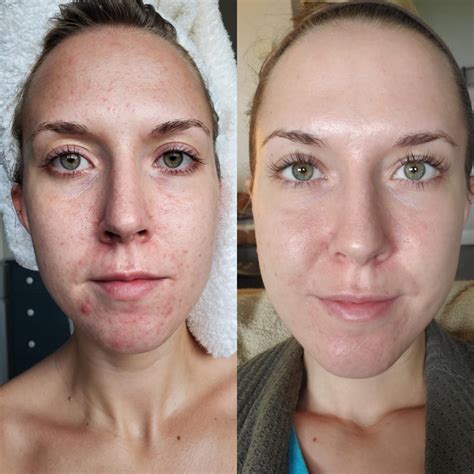 Acne 9 Months On Differin And 6 Weeks Sober Ive Been Battling Acne